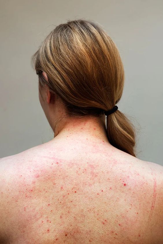 woman's back with acne to answer the question; can hard water cause acne
