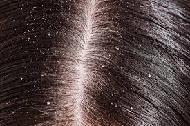 Can Hard Water Cause Dandruff? The Science of Dandruff and 3 Key Solutions